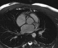 Bicuspid aortic valve with aortic coarctation (Radiopaedia 29895-30410 Oblique SSFP Cine 10).jpg