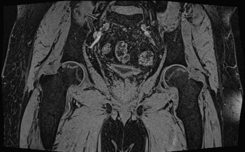 File:Bilateral avascular necrosis of femoral head (Radiopaedia 77116-89078 Coronal T2 we 29).jpg