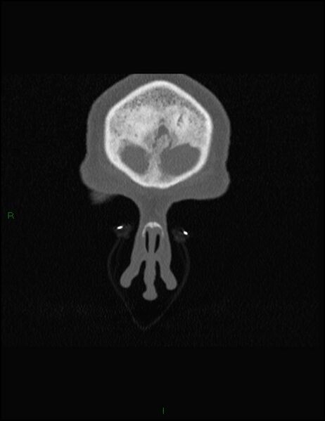 File:Bilateral frontal mucoceles (Radiopaedia 82352-96454 Coronal 35).jpg