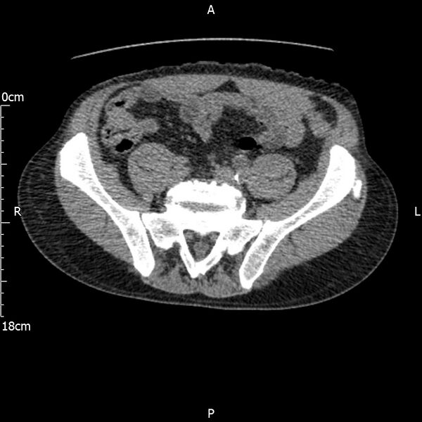 File:Bilateral medullary nephrocalcinosis with ureteric calculi (Radiopaedia 71269-81569 Axial non-contrast 94).jpg