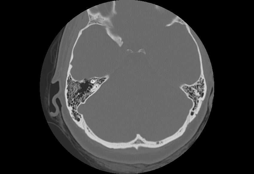 Bilateral otospongiosis (Radiopaedia 35447-36940 B 44).jpg