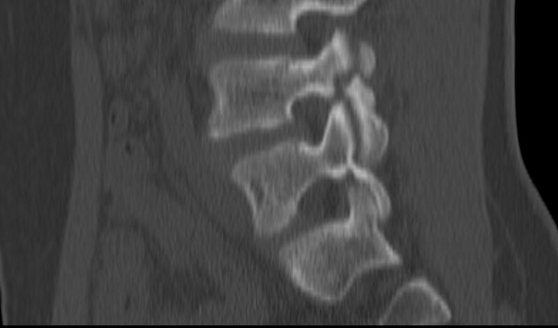 File:Bilateral pars defect (Radiopaedia 26691-26846 Sagittal bone window 40).jpg