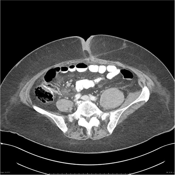 File:Bilateral psoas hematomas (Radiopaedia 24057-24279 A 59).jpg