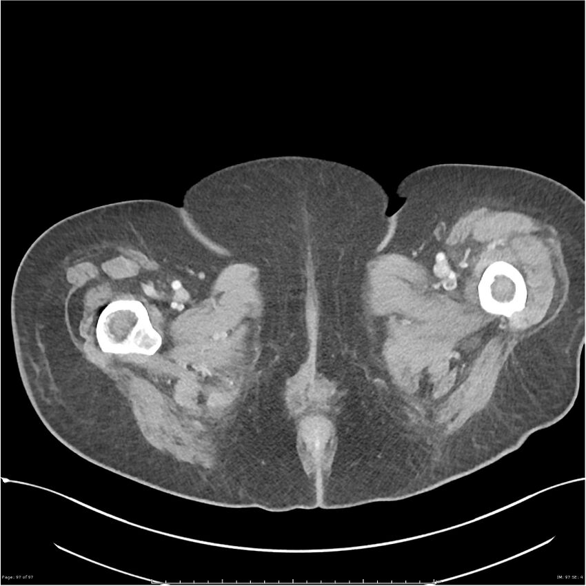 Bilateral psoas hematomas (Radiopaedia 24057-24279 A 98).jpg