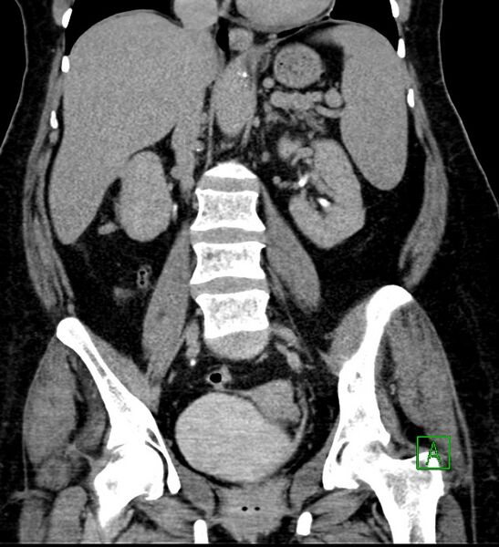 File:Bilateral sporadic synchronous clear cell renal cell carcinoma (Radiopaedia 85035-100575 I 34).jpg