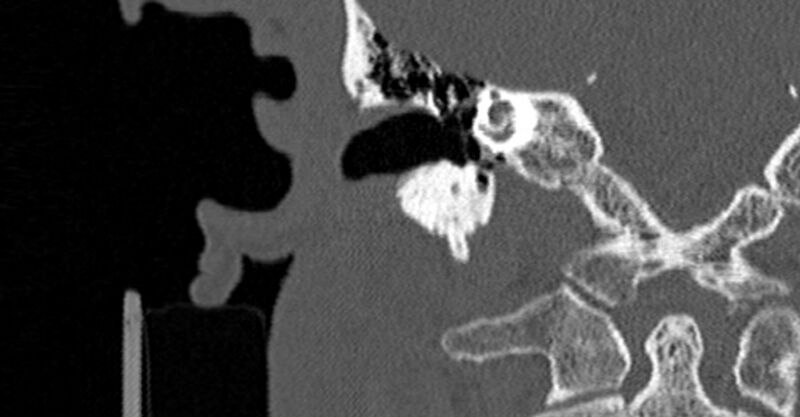 File:Bilateral temporal bone fractures (Radiopaedia 29482-29970 Coronal non-contrast 101).jpg