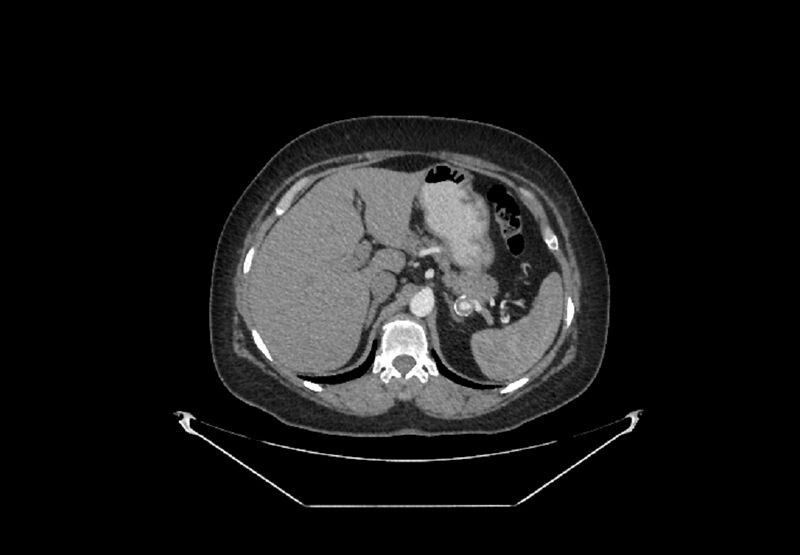File:Bilateral urolithiasis with incidentally detected splenic artery aneurysm and left inferior vena cava (Radiopaedia 44467-48127 A 11).jpg