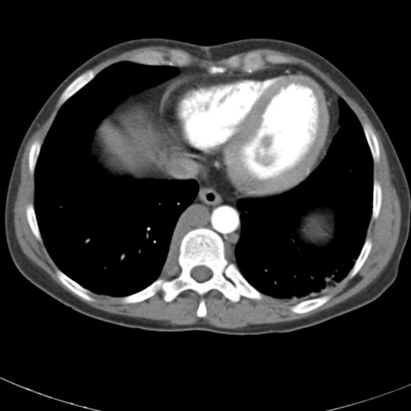 File:Biliary necrosis - liver transplant (Radiopaedia 21876-21845 A 4).jpg