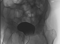 Bladder leak post radical prostatectomy (Radiopaedia 34569-35946 B 1).PNG