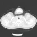 Bochdalek diaphragmatic hernia (Radiopaedia 38866-41059 Axial lung window 1).jpg