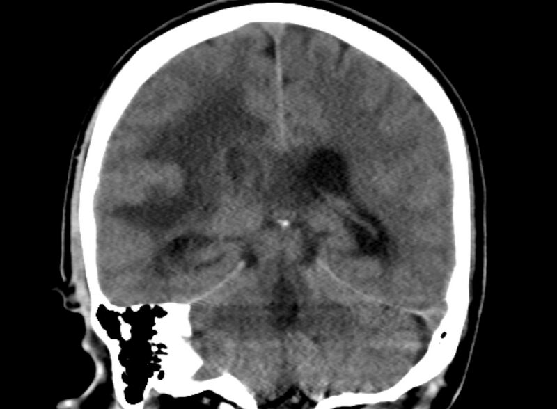 File:Brain abscess complicated by intraventricular rupture and ventriculitis (Radiopaedia 82434-96575 Coronal non-contrast 17).jpg