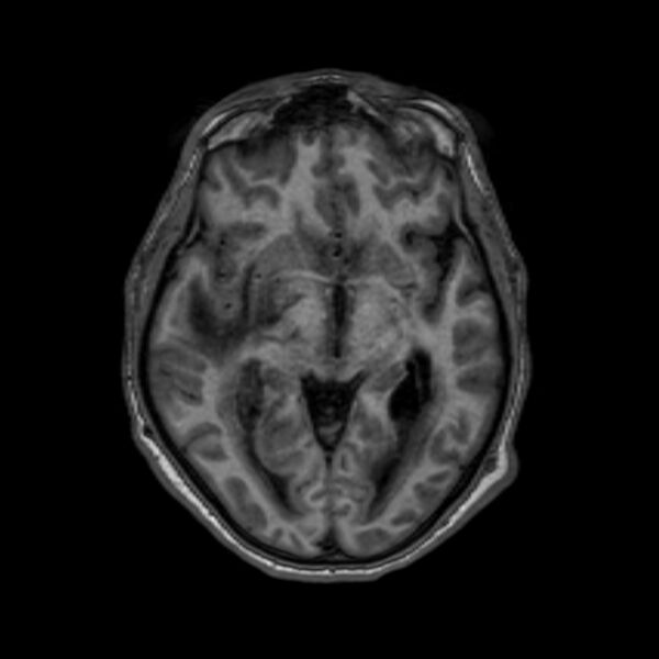 File:Brain abscess complicated by intraventricular rupture and ventriculitis (Radiopaedia 82434-96577 Axial T1 30).jpg