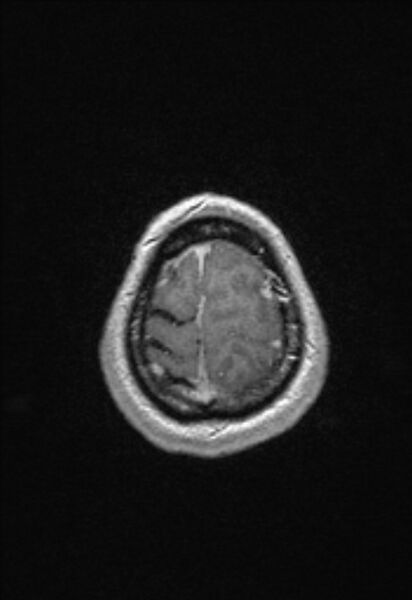 File:Brain abscess with ventriculitis (Radiopaedia 85703-101495 Axial T1 C+ 153).jpg