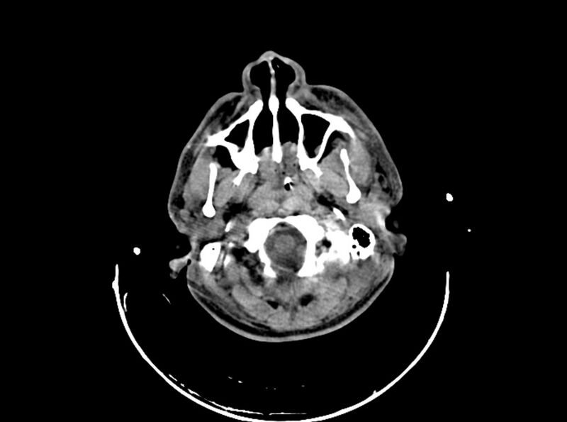File:Brain injury by firearm projectile (Radiopaedia 82068-96087 B 41).jpg