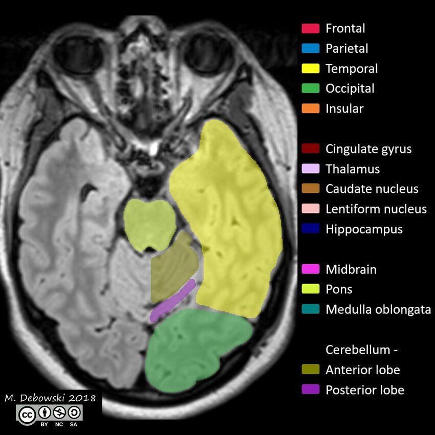 Brain lobes - annotated MRI (Radiopaedia 61691-69700 Axial 52).JPG