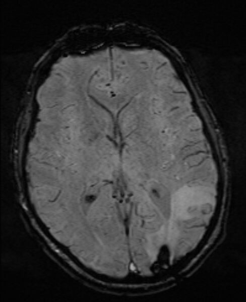 File:Brain metastases - lung cancer primary (Radiopaedia 75060-86115 Axial SWI 33).jpg