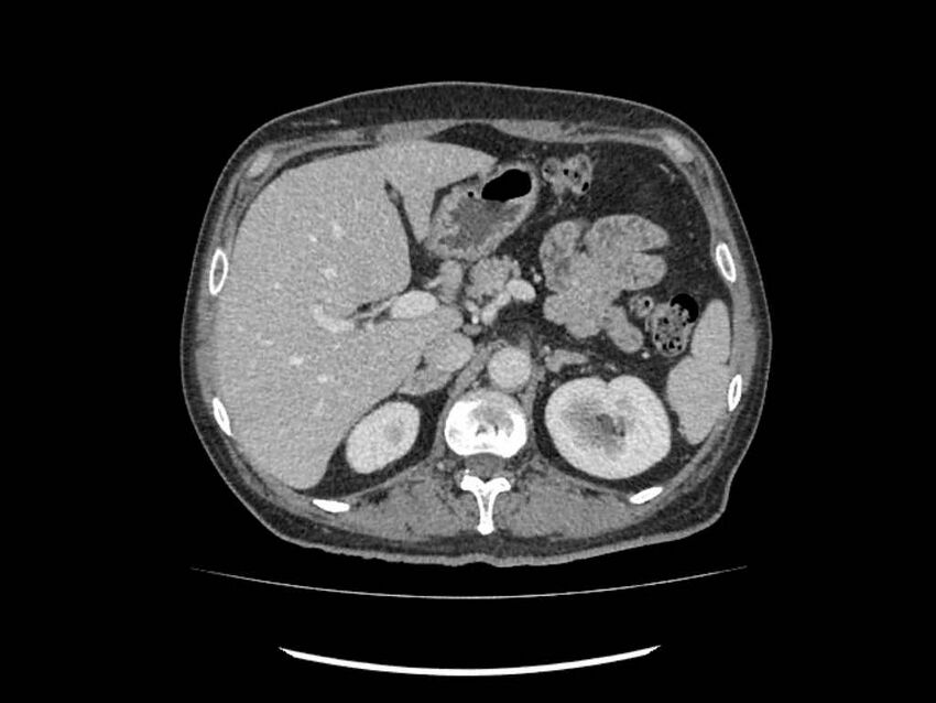 Brain metastases from renal cell carcinoma (Radiopaedia 42222-45328 B 40).jpg