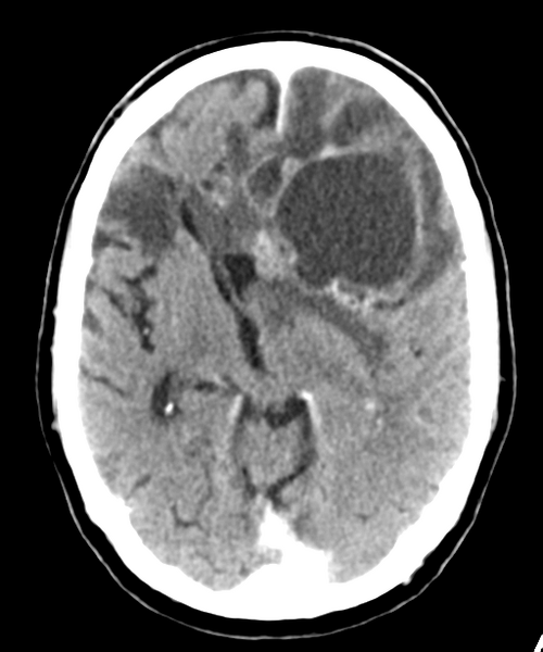 File:Brain metastasis (lung cancer) (Radiopaedia 48289-53177 Axial C+ 14).png