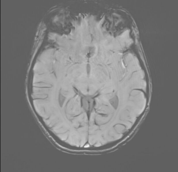 File:Brainstem glioma (Radiopaedia 70548-80674 Axial SWI 28).jpg