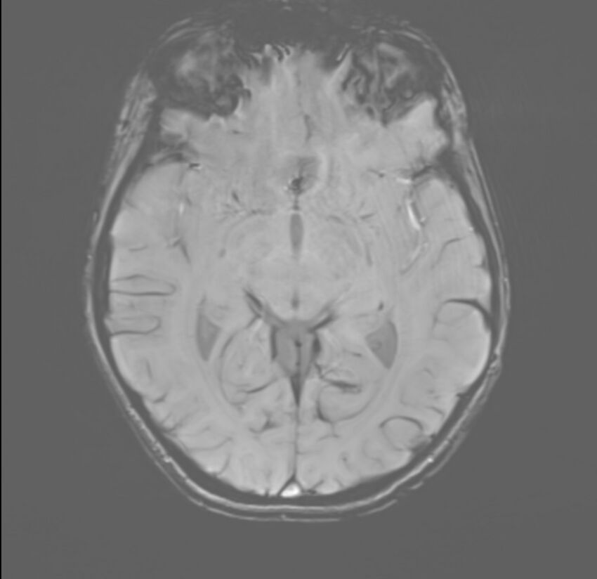 Brainstem glioma (Radiopaedia 70548-80674 Axial SWI 28).jpg