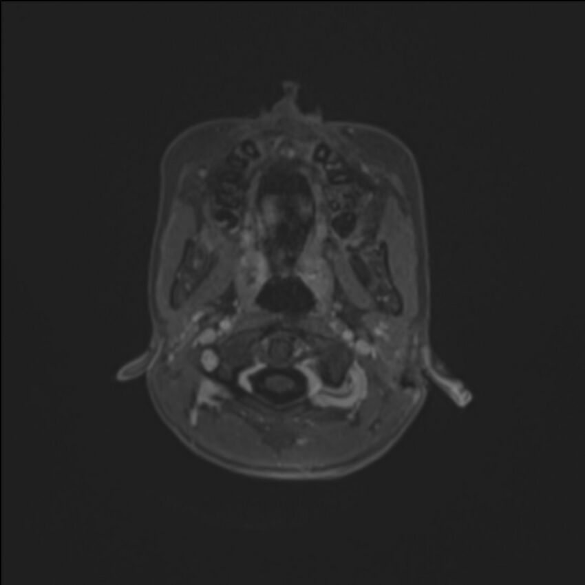 Brainstem glioma (Radiopaedia 70548-80674 Axial T1 C+ 11).jpg