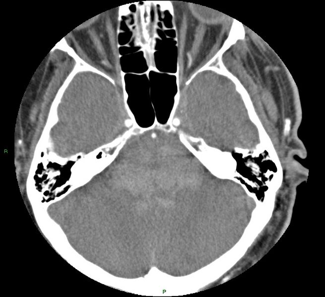 File:Brainstem hemorrhage (Radiopaedia 58794-66028 D 55).jpg