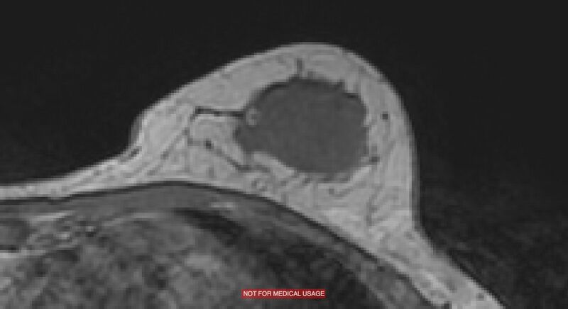 File:Breast lymphoma (MRI) (Radiopaedia 34999-36498 Axial T1 16).jpg