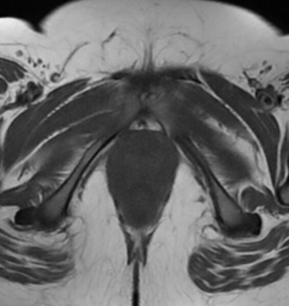 File:Broad ligament leiomyoma (Radiopaedia 81634-95516 Axial T1 27).jpg