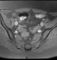 Broad ligament leiomyoma (Radiopaedia 81634-95516 Axial T1 fat sat 8).jpg