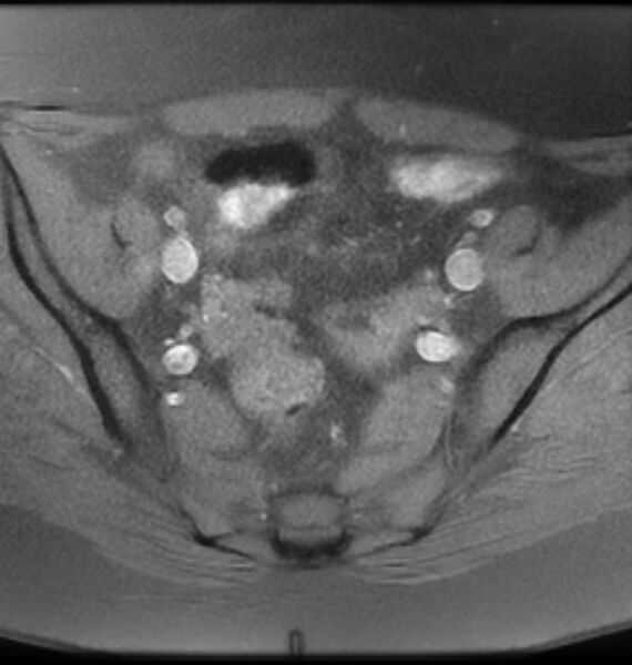 File:Broad ligament leiomyoma (Radiopaedia 81634-95516 Axial T1 fat sat 8).jpg