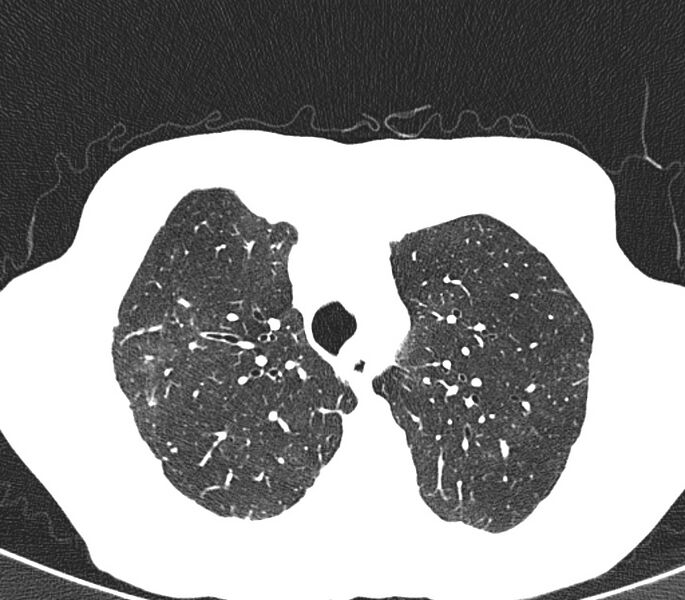 File:Bronchiolitis (Radiopaedia 24616-24887 Axial lung window 10).jpg