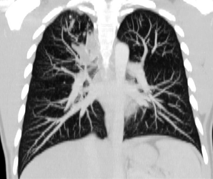 File:Bronchocele (Radiopaedia 12104-12460 Coronal lung window 11).jpg