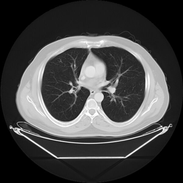 File:Bronchogenic carcinoma with upper lobe collapse (Radiopaedia 29297-29726 Axial lung window 17).jpg