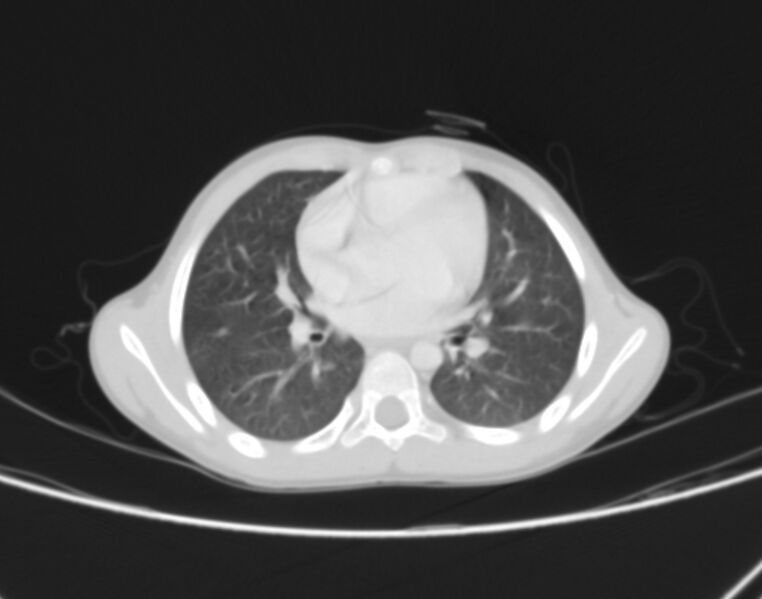 File:Bronchus suis (Radiopaedia 68131-77620 Axial lung window 48).jpg