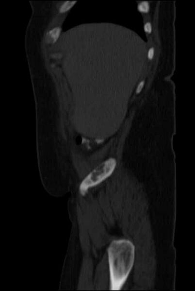 File:Brown tumors compressing the spinal cord (Radiopaedia 68442-77988 H 9).jpg