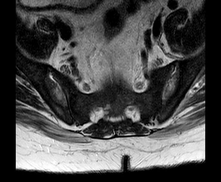 File:Brown tumors compressing the spinal cord (Radiopaedia 68442-78030 Axial T2 - lumbar 8).jpg