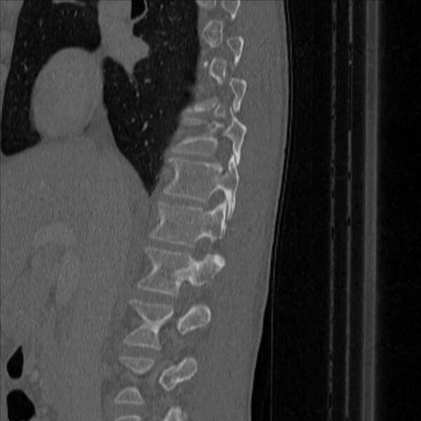 File:Bulging of paraspinal line in traumatic thoracal spinal compression fracture (Radiopaedia 29221-35872 Sagittal bone window 8).jpg