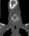 Butterfly vertebra (Radiopaedia 77903-90209 Coronal bone window 9).jpg