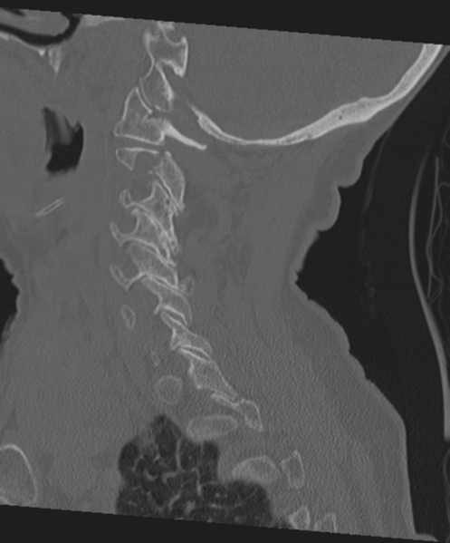 File:C2 fracture with vertebral artery dissection (Radiopaedia 37378-39199 Sagittal bone window 52).png