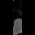 C5 facet fracture (Radiopaedia 58374-65499 Sagittal bone window 2).jpg