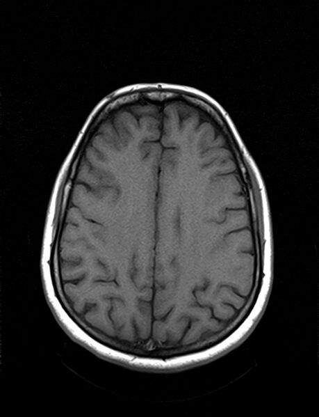 File:Calcified cerebral hydatid cyst (Radiopaedia 65603-74699 Axial T1 16).jpg