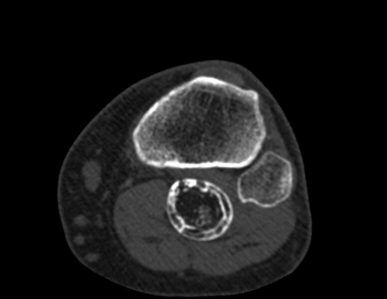 File:Calcified hematoma - popliteal fossa (Radiopaedia 63938-72763 Axial bone window 69).jpg