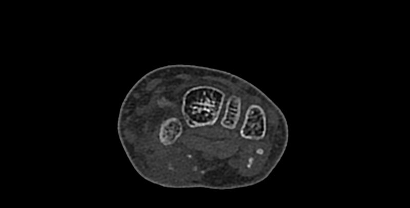 File:Calcifying aponeurotic fibroma (Radiopaedia 88423-105064 Axial bone window 77).jpg