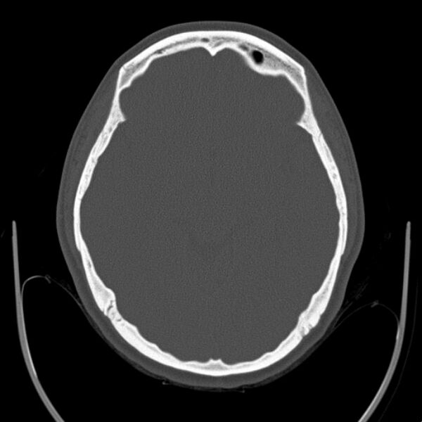 File:Calvarial osteoma (Radiopaedia 36520-38079 Axial bone window 46).jpg