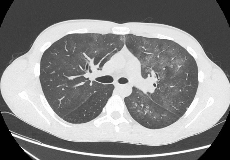 File:Cannabis-induced diffuse alveolar hemorrhage (Radiopaedia 89834-106946 Axial lung window 44).jpg