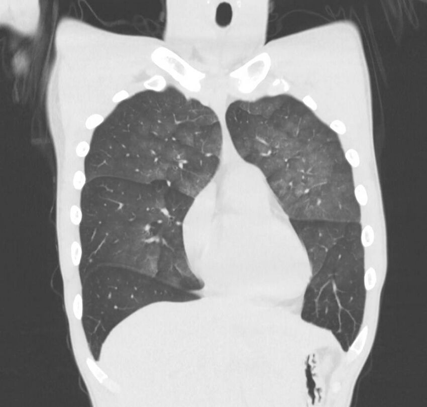 Cannabis-induced diffuse alveolar hemorrhage (Radiopaedia 89834-106946 Coronal lung window 66).jpg