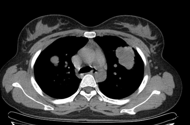 File:Cannonball metastases - uterine choriocarcinoma (Radiopaedia 70137-80173 Axial non-contrast 33).jpg