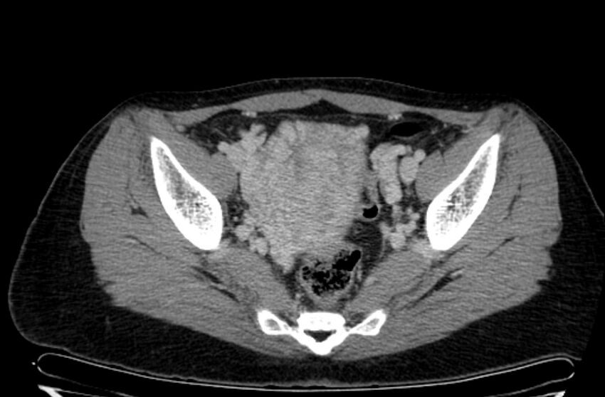 Cannonball metastases - uterine choriocarcinoma (Radiopaedia 70137-80174 A 22).jpg