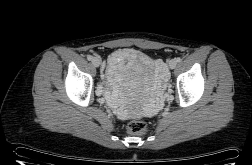 Cannonball metastases - uterine choriocarcinoma (Radiopaedia 70137-80174 A 32).jpg