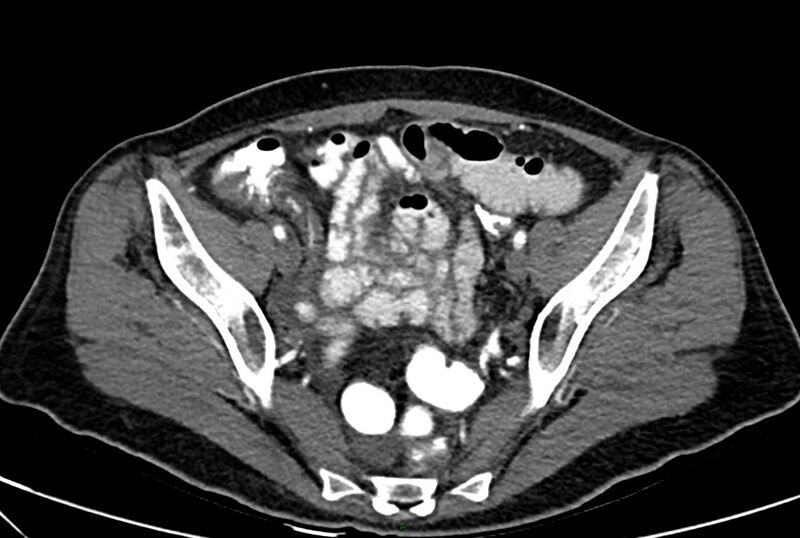 File:Carcinoid mesenteric tumor complicated by chylous ascites (Radiopaedia 76312-88926 A 61).jpg